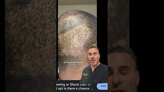 #shorts #hairtransplant #hairrestoration