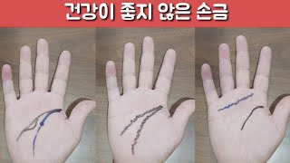 건강이 좋지 않은 손금. [건강 주의 요함]