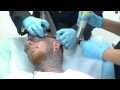 Crazy Video of Man Getting Face Tattoo Removed