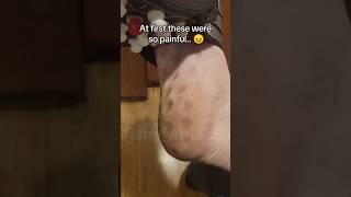 Acupressure Slipper For Body Pain, Blood Circulation, Acupressure Points