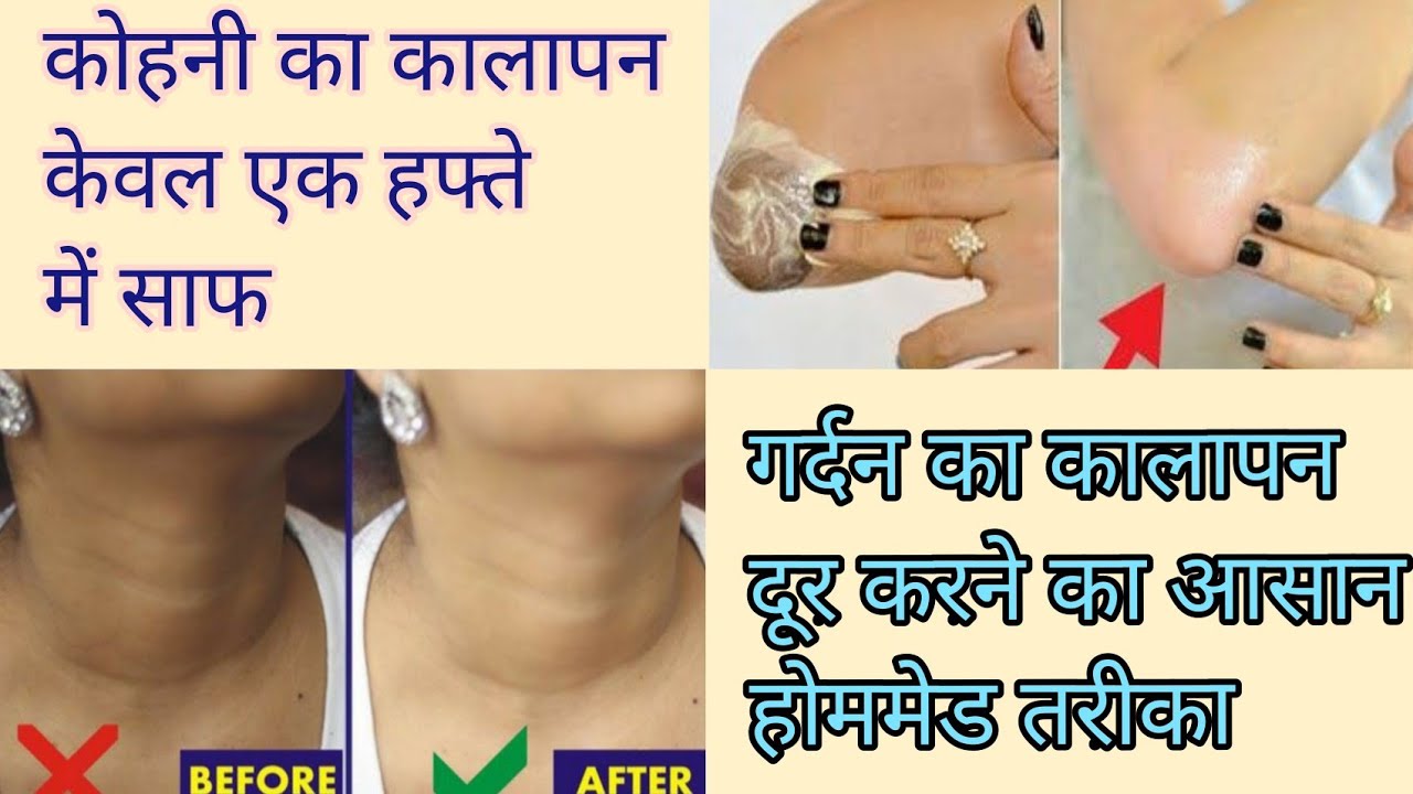 Gardan ka kalapan kese door kare,गर्दन का कालापन दूर करने का आसान ...
