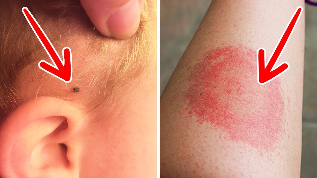Pay Attention To These Signs And You Will Recognize Lyme Disease At An