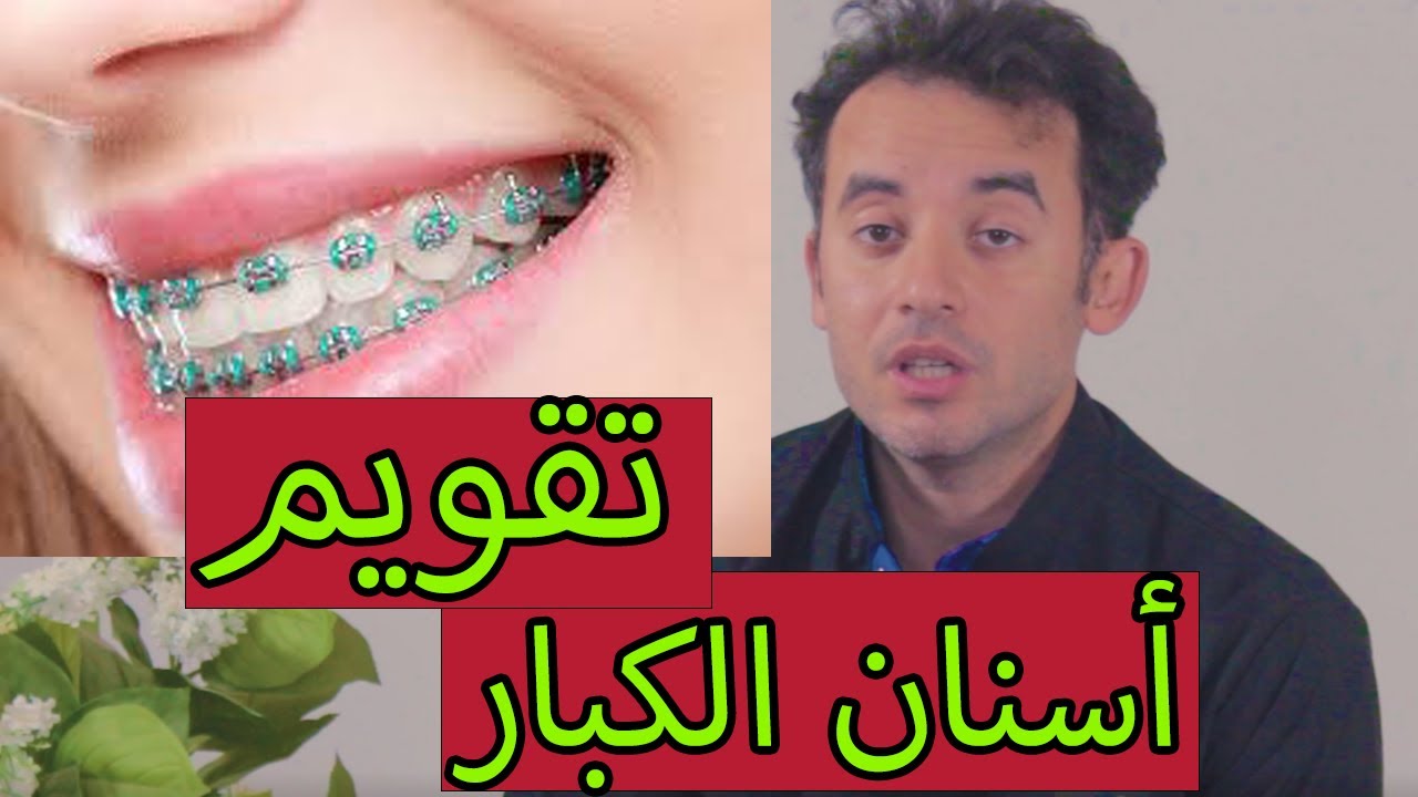 تقويم الأسنان للبالغين ومعلومات مهمة ليك لوبتفكر فى التقويم