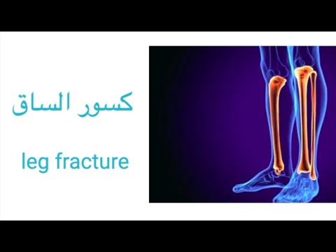   كسور الساق