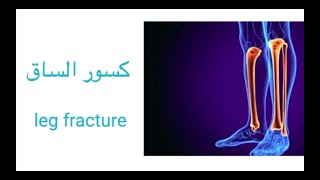 leg fracture / كسور الساق