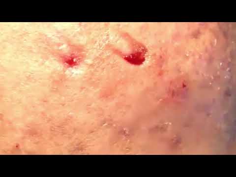 cystic acne, pimples and blackheads extraction acne treatment on face!!! part 