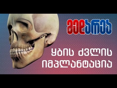 ყბის ძვლის იმპლანტაცია
