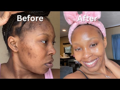 How I Cleared My Acne + Dark Spots + Hyperpigmentation for good in 1 month (NO ACCUTANE) VIDEO PROOF