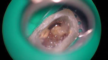 17777 broken file removal with TFRK ultraonics tips