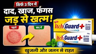 Itch Guard Cream Uses In Hindi Daad, Khujli, Fungal Infection Itch Guard Itch Guard Cream