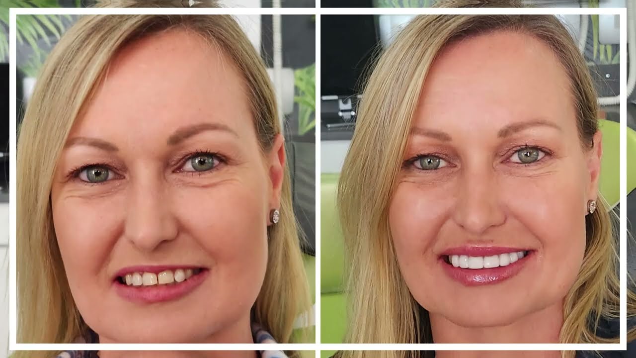 A beautiful smile makeover by Dr Gerhard