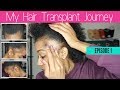 Why I Decided to Get a Hair Transplant + My Struggle With Traction Alopecia - Episode 1