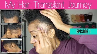 Why I Decided to Get a Hair Transplant + My Struggle With Traction Alopecia - Episode 1