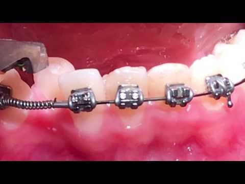 Crimpable stop-open coil spring- orthodontics