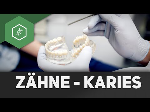 Video: Karies - Ursachen, Stadien, Diagnose, Behandlung, Prävention