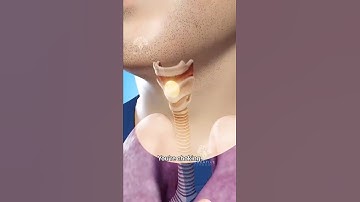 How to Survive Choking When You