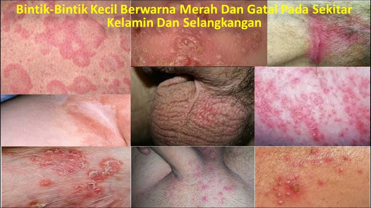 Bintik-Bintik Kecil Berwarna Merah Dan Gatal Pada Sekitar Kelamin Dan
