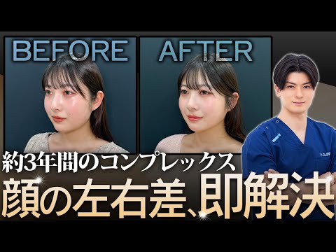 【顔の左右差なくしたい】腫れも痛みも少ない1day小顔®︎で施術直後でもすっきりとしたフェイスラインに！