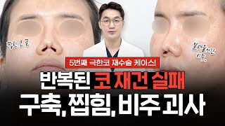 5번째 코재수술｜염증과 구축으로 비주 괴사, 말림, 콧구멍 찝힘, 비중격 천공까지!?｜코 재건 실패로 자가늑연골 채취만 3번째..😟극한코 케이스 리뷰