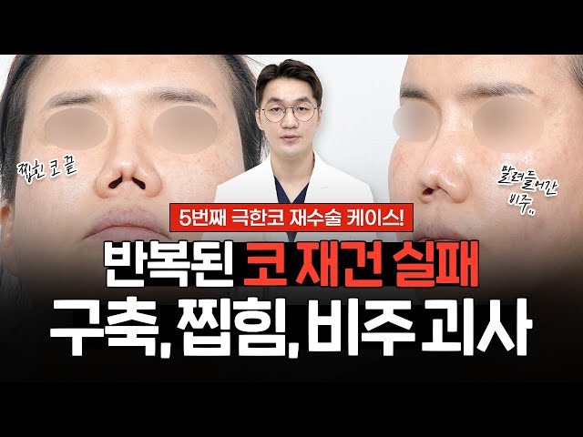 5번째 코재수술｜염증과 구축으로 비주 괴사, 말림, 콧구멍 찝힘, 비중격 천공까지!?｜코 재건 실패로 자가늑연골 채취만 3번째..😟극한코 케이스 리뷰