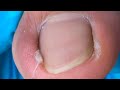 One Side Of The Ingrown Nail Is Stuffed With Cotton
