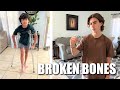 OUR KIDS BROKEN + FRACTURED + SPRAINED BONES | Broken or Fractured Foot and Badly Sprained Finger