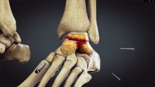 Ankle Fixation Animation - Surgery Animation