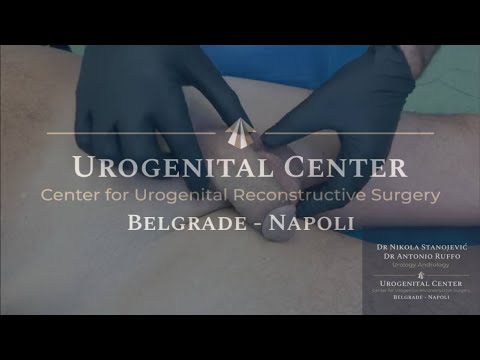 Inflatable penile prosthesis - Demonstration video