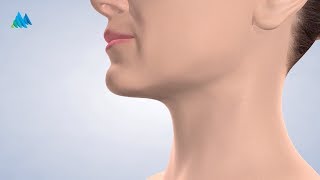 Face and Neck Liposuction in Charleston WV | Mountain State Oral & Facial Surgery