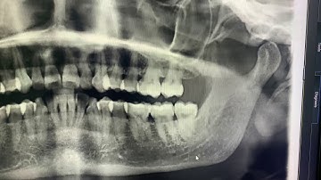 Distoangulaire geïmpacteerde derde kies | Extractie van verstandskiezen