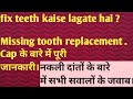 फिक्स दांत कैसे लगाते हैं ? Missing tooth replacement .