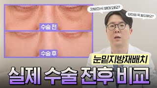 활기 넘치는 동안으로 변신! 눈밑지방재배치 수술 전후 비교✨ 1주차, 2달차 환자 사진 리뷰