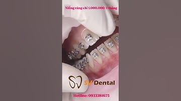 NIỀNG RĂNG TRẢ GÓP CHỈ $1.000.000/THÁNG$ - LÀM SAO ĐỂ CÓ NỤ CƯỜI ĐẸP? | Nha Khoa SV