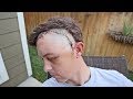 Revealing My Face After Brain Surgery (Graphic)