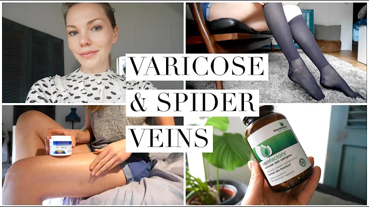 Spider Veins Treatment At Home - DayDayNews