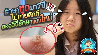 รักษาหูดมา 7 ปี ไม่หายสักที ลองวิธีรักษาแบบใหม่