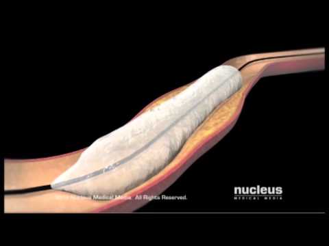 Non Cardiac Percutaneous Transluminal Angioplasty