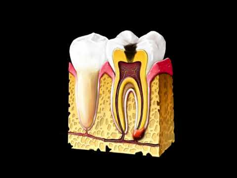 Video: Ktoré streptokoky sa podieľajú na vzniku zubného kazu?