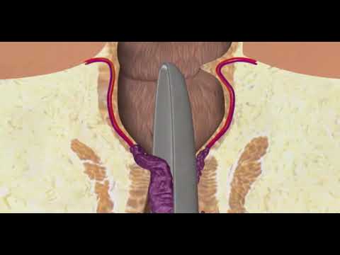 تكلفة عملية البواسير في السعودية 2025