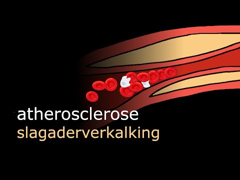 Video: Atherosclerose Van Bloedvaten - Behandeling, Symptomen, Prognose