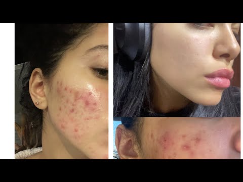 HOW I GOT RID OF MY ACNE