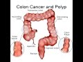 Colon Cancer