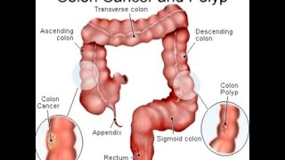 Colon Cancer