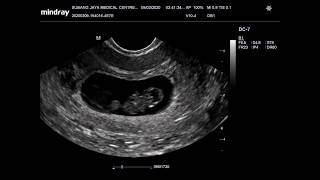 Ultrasound scan pregnancy 8 weeks (File OB1)