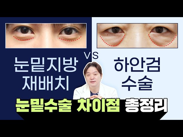 불룩한 눈밑지방, 재배치 해야할까 하안검 해야할까? 눈밑성형 A to Z