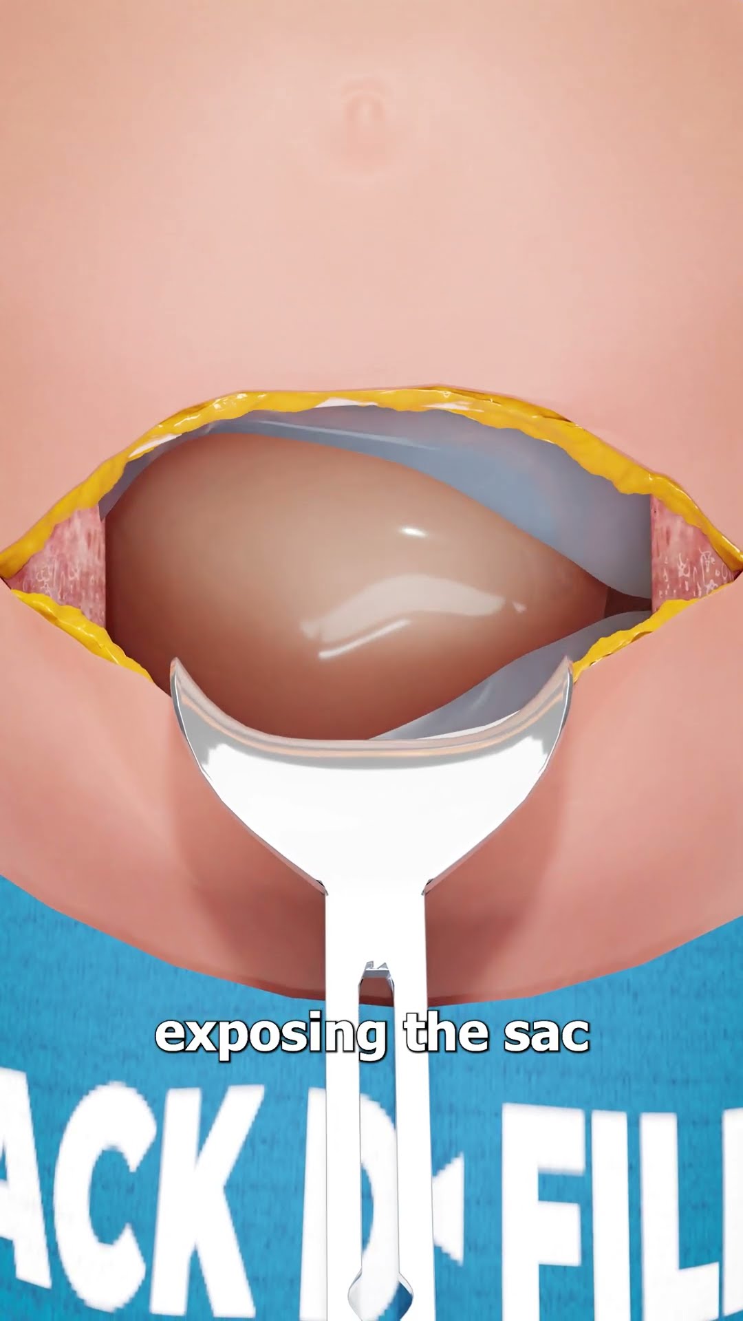 How A C-Section Is Performed ?