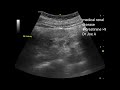 Severe medical renal disease: ultrasound and color Doppler video