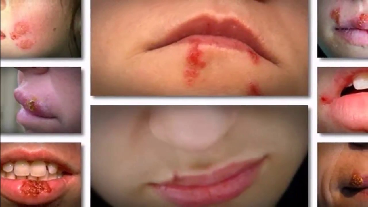 how-to-get-rid-of-herpes-virus-fast-youtube