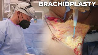 Brachioplasty - Dr. Michael Jones | Lexington Plastic Surgeons