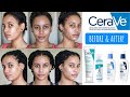 I Tried CeraVe's NEW Acne Skin Care Routine & This Happened!
